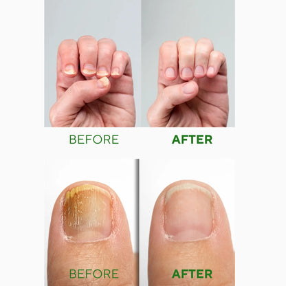 УКРЕПВАЩ СЕРУМ ЗА НОКТИ с масло от Чаено дърво, Салицилова киселина, Алантоин и Глицерин - 30ml